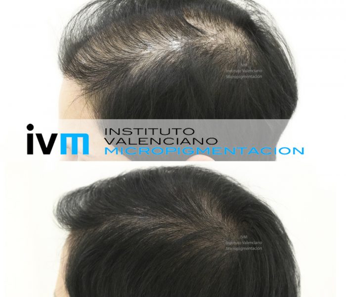 tricopigmentacion, ivm, capilar, micropigmentacion, pigmentacion, estetica, alopecia, tratamiento
