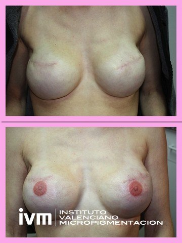 Recontrucciona-Areolas-IVM-5