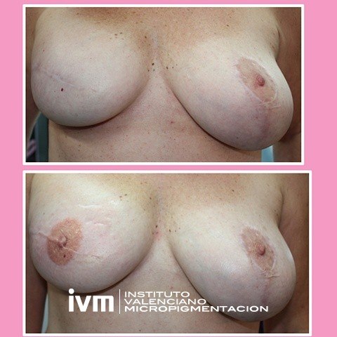 Reconstruccion-Areola-IVM-8