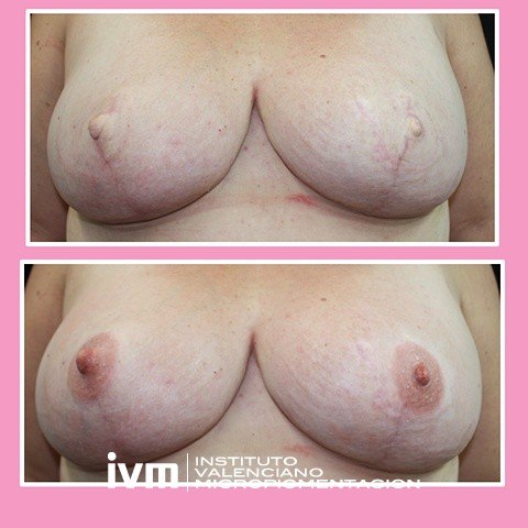 Recontrucciona-Areolas-IVM-8