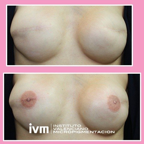 Recontrucciona-Areolas-IVM-9