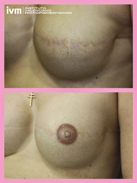 Reconstruccion-Areola-IVM-5